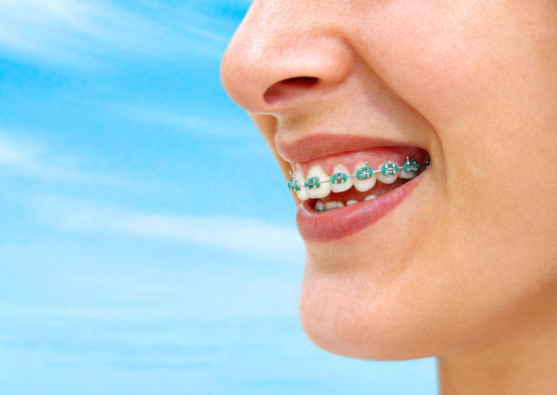 Invisalign and Your Local Dentist in Evanston