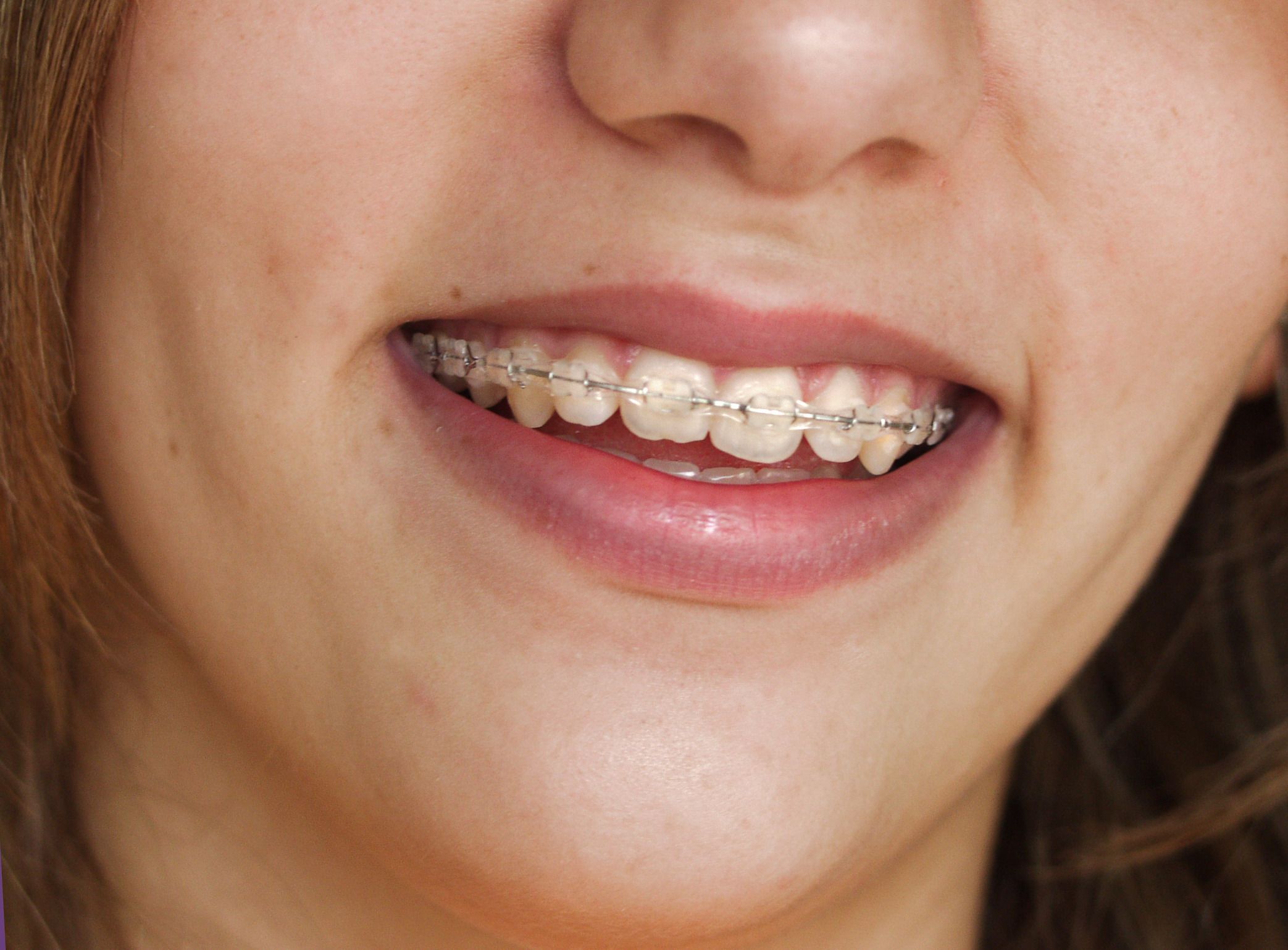 Choosing a Lingual Brace in Toms River, NJ Might Be the Answer if You Have Apprehensive About Your Braces