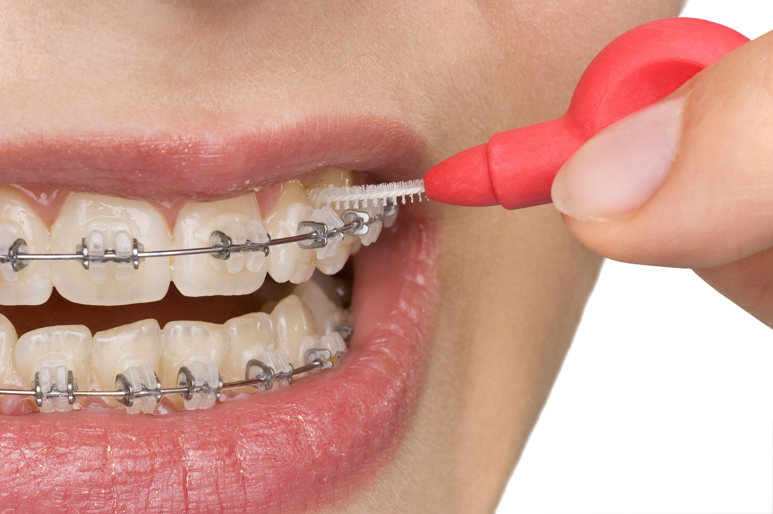 Discover the Benefits of Orthodontic Treatment in Long Beach, CA